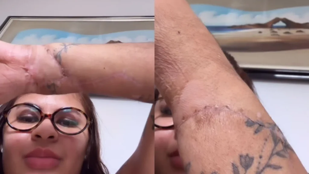 Jovem Ana Clara, que teve mãos amputadas, mostra marcas de cicatrizes: ‘Milagre’