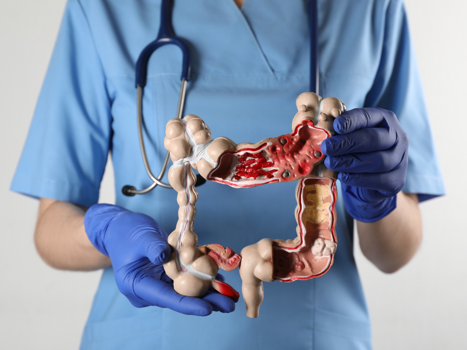 Avanço na saúde: teste de fezes para rastrear câncer de intestino chega ao SUS