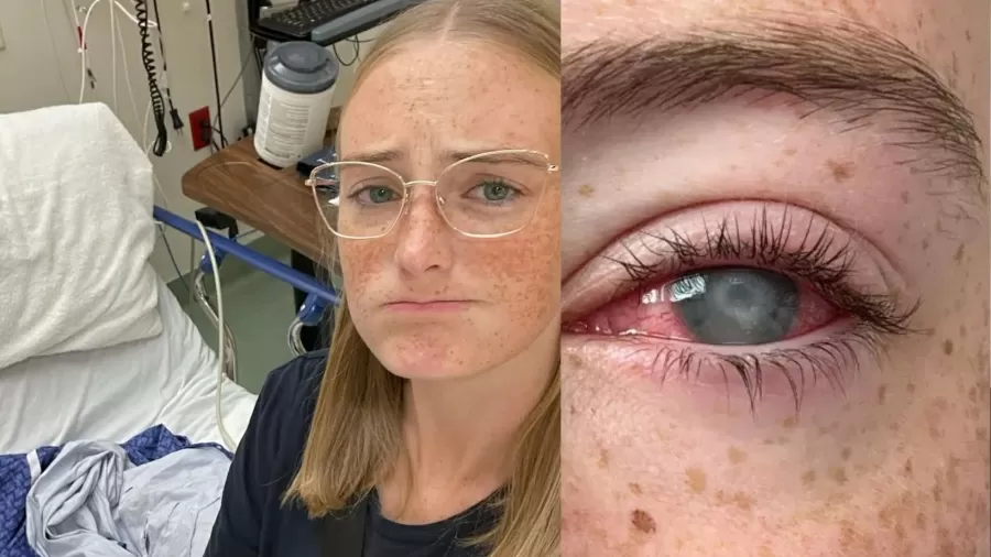 Jovem de 20 anos perde a visão após infecção rara causada por hábito comum com lentes de contato