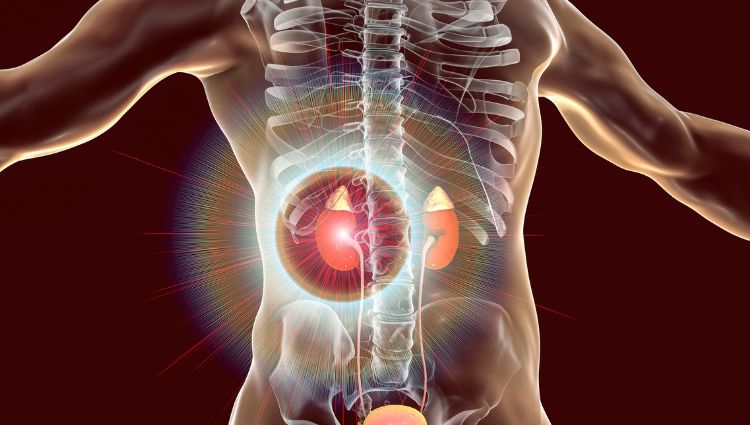 Pedra nos rins pode levar à perda da função renal: litíase afeta até 15% da população e especialistas alertam para riscos do problema negligenciado