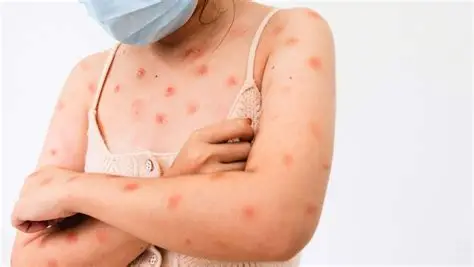 Ceará registra cinco casos de mpox e descarta outras 60 notificações em 2026