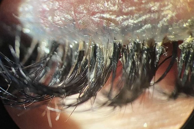 Extensão de cílios pode favorecer proliferação de ácaros e irritação nos olhos, aponta estudo