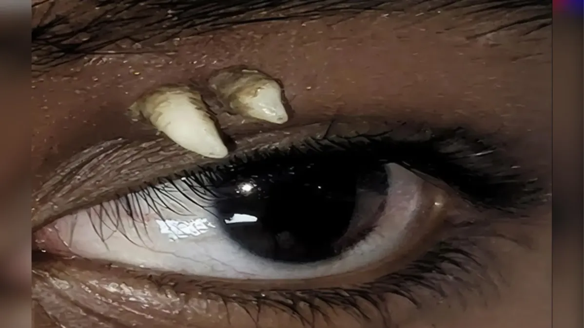 Caso raro: adolescente na Índia descobre dente acima do olho